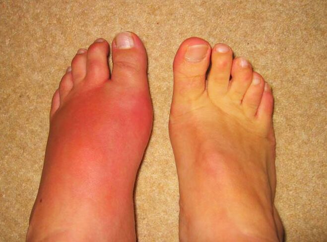 болка в ставите на краката поради подагра