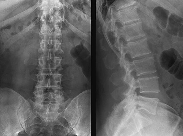 Рентгенова снимка за диагностика на остеохондроза