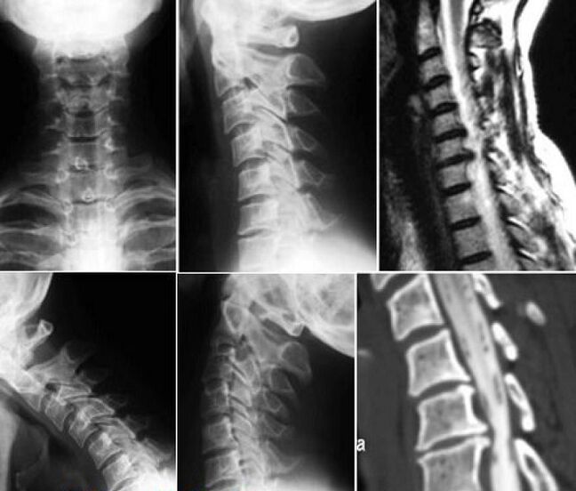 Рентгенова снимка на шийните прешлени за диагностика на остеохондроза