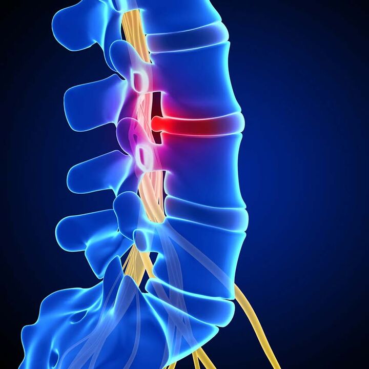 Протрузия на междупрешленния диск в гръбначния канал в резултат на остеохондроза на лумбалния гръбначен стълб