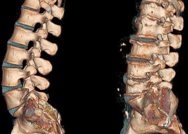 Остеохондроза на гръбначния стълб при компютърна томография