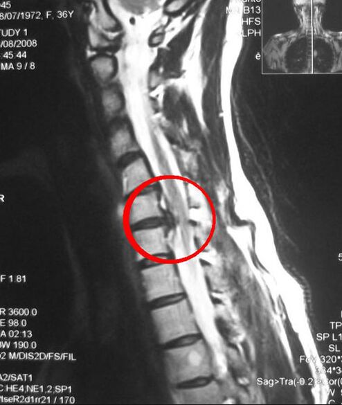 Симптоми на гръдна остеохондроза на рентгенова снимка
